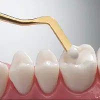 لمینت و کامپوزیت برای همه مناسب نیست