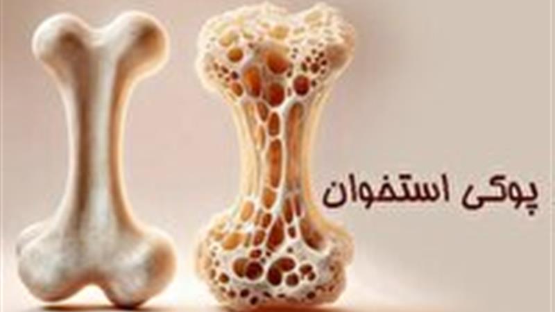 مراقب پوکی استخوان در دهه چهارم زندگی باشید