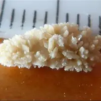 رباتی که سنگ کلیه را دفع می‌کند