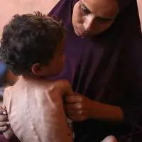 سوء تغذیه شدید ۴۰هزار کودک در نوار غزه