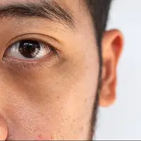 «چشم پاندایی» چیست؟