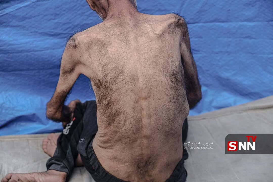 عکس/ وخامت حال سالمندان فلسطینی در پی ادامه محاصره و جنگ گرسنگی در غزه