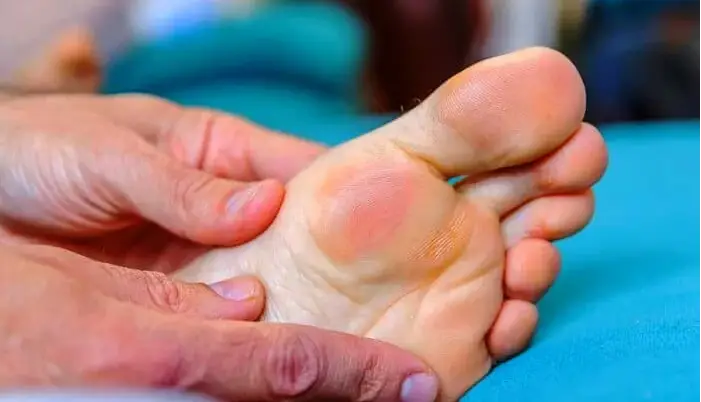 چرا پاها مدام تاول می‌زند؟!