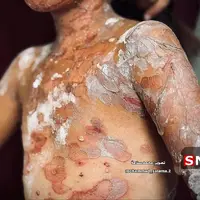عکس/ تصاویری دردآور از ابتلای کودک فلسطینی به بیماری‌های پوستی