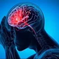 نشانه‌های مهم سکته مغزی را بشناسید