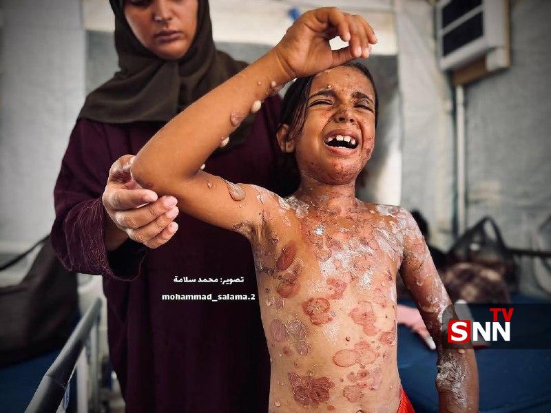 عکس/ تصاویری دردآور از ابتلای کودک فلسطینی به بیماری‌های پوستی