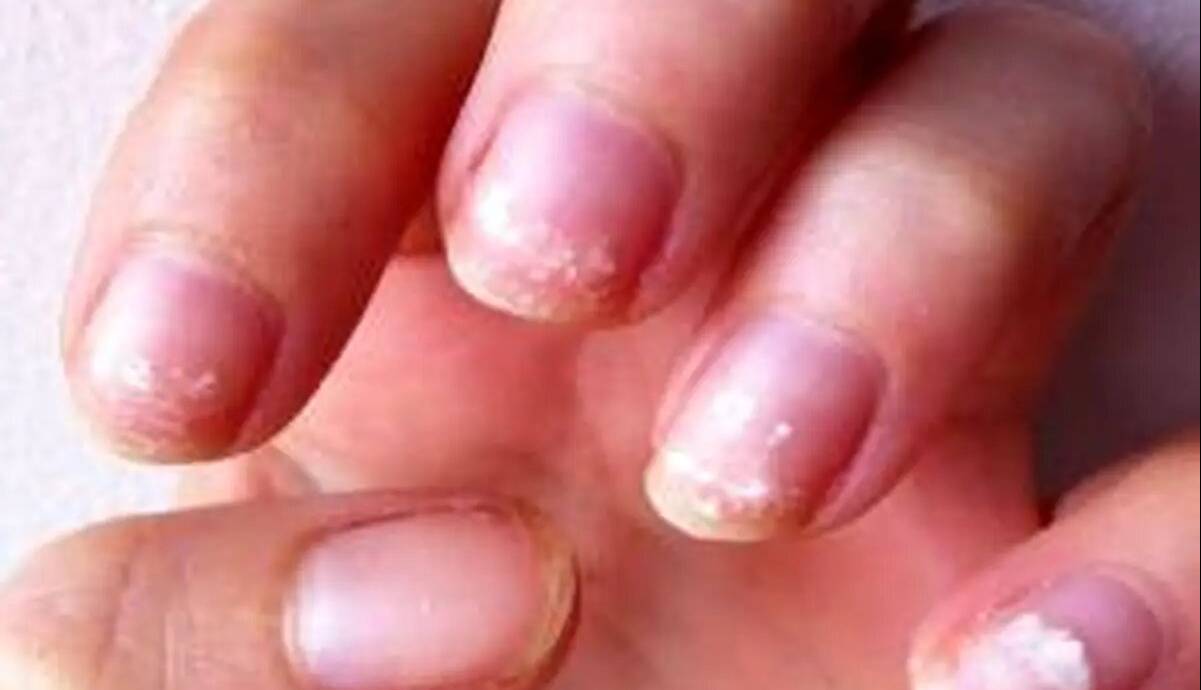 روش تشخیص کمخونی از روی پوست دست