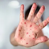 ابتلای ۲۹ نفر به بیماری سرخک در بابل