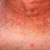 هنوز هم مخملک خطرناک است؟