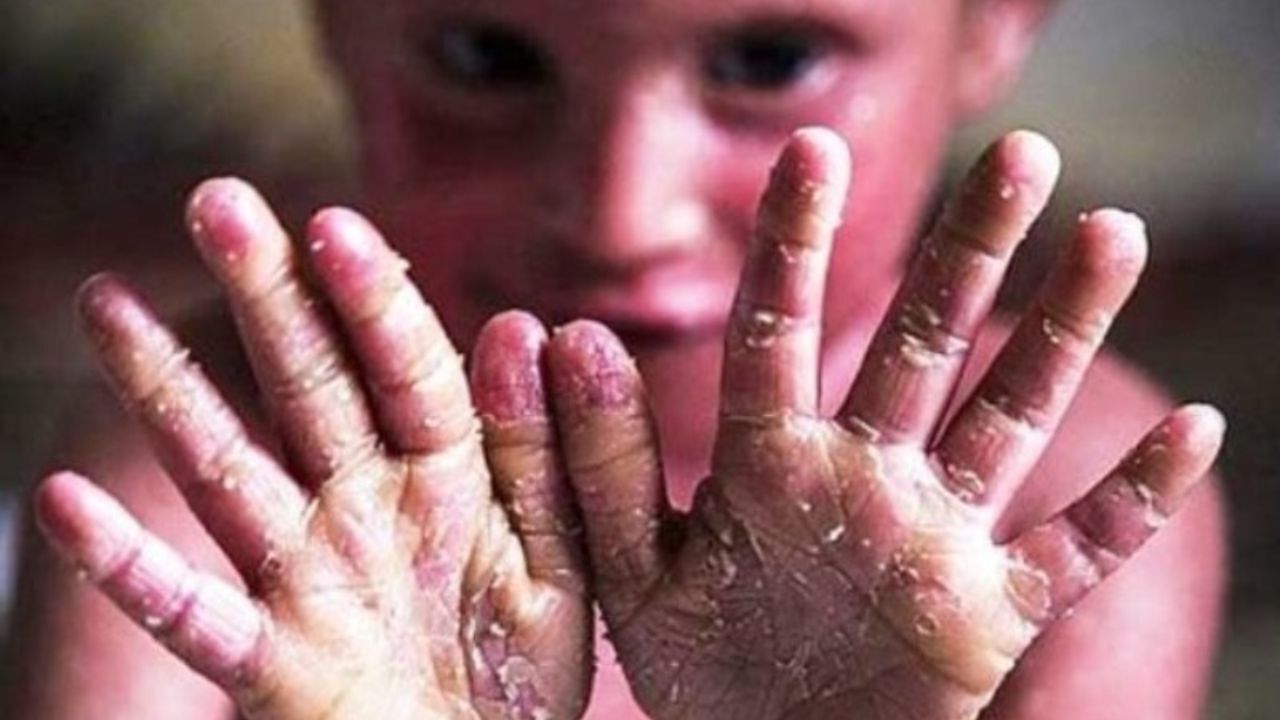 ۳۳ بیمار پروانهای در همدان از بهزیستی خدمات دریافت می کنند