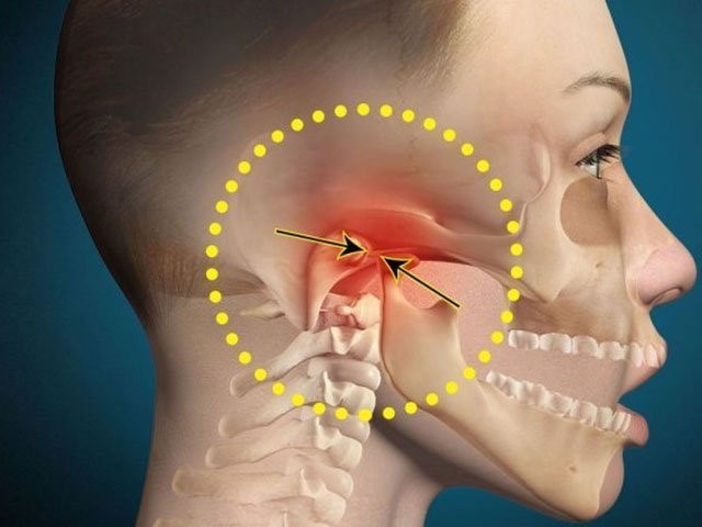 چگونه می‌توان درد اختلال مفصل گیجگاهی فکی یا TMJ را تسکین داد؟
