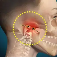 چگونه می‌توان درد اختلال مفصل گیجگاهی فکی یا TMJ را تسکین داد؟