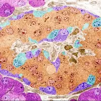 ویرایش ژن، امیدی تازه برای درمان دیابت نوع یک