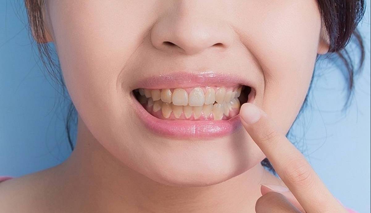 رنگ دندان‌ها چه می‌گوید؟