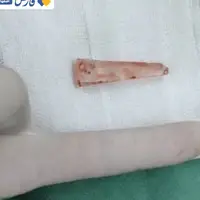 دقت پزشک جان پسر بچه‌ای را در اصفهان نجات داد