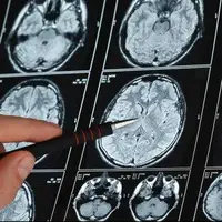 تشخیص زودهنگام آلزایمر با اسکن مغزی جدید