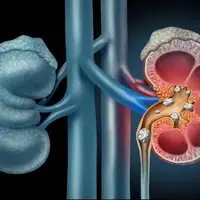 اولین دوا برای سنگ کلیه آب است