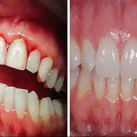 رژیم غذایی مدیترانه‌ای می‌تواند بیماری لثه را کاهش دهد
