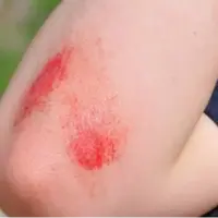 زخم‌ها چگونه خوب می‌شوند؟