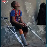  لوله پلاستیکی جای پای قطع شده کودک فلسطینی را گرفت