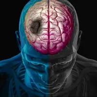 ترکیبات طبیعی، امید تازه در کاهش آسیب‌های سکته مغزی