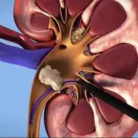 چه زمانی درد سنگ کلیه آشکار می‌شود؟ 