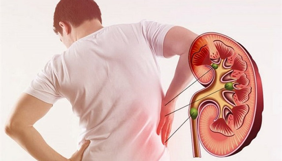 هنگام درد شدید کلیه چه کاری انجام بدهیم؟ 
