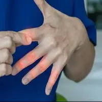هشدار درباره بی‌حسی و درد انگشتان