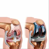 آیا فرد دیابتی می تواند عمل جراحی زانو انجام دهد؟