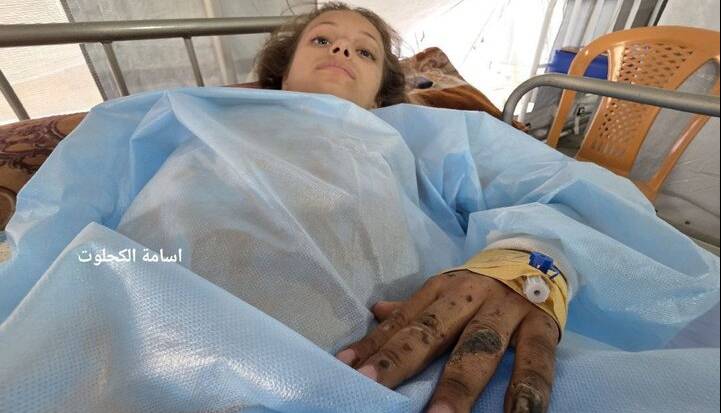«نور»؛ دختر بچه‌ فلسطینی که پس از بمباران، ۳ عضو بدنش را از دست داد