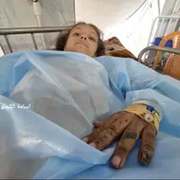 «نور»؛ دختر بچه‌ فلسطینی که پس از بمباران، ۳ عضو بدنش را از دست داد