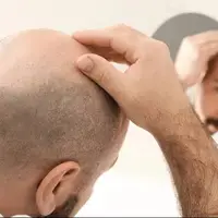 طاسی درمانی بجز کاشت دارد؟ 