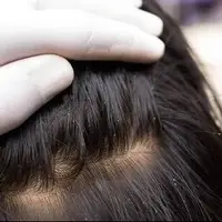 راهکار خلاصی کودک از شپش را بشناسید