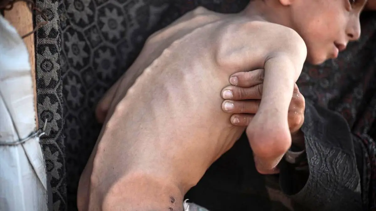 عکس/ تصاویری دردناک از سوءتغذیه کودک ۱۰ ساله اهل غزه