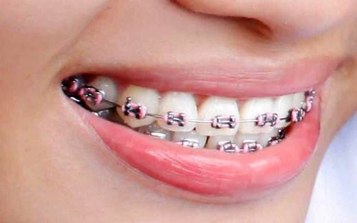 چرا بیماران ارتودنسی باید بیشتر به بهداشت دهان توجه کنند؟