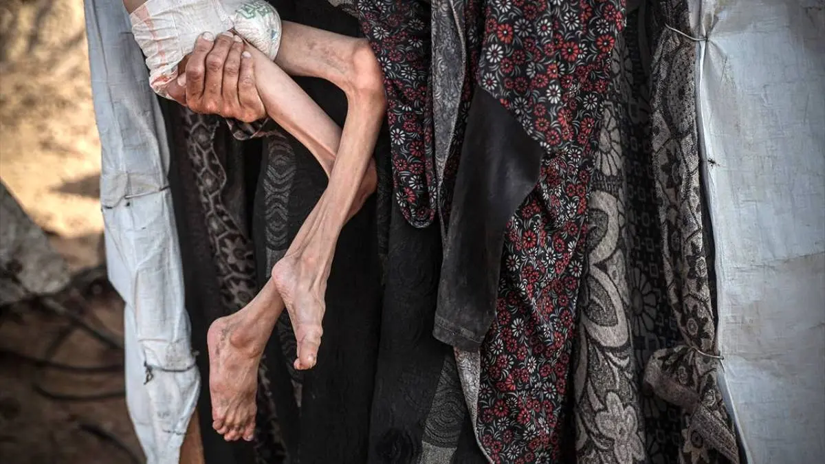 عکس/ تصاویری دردناک از سوءتغذیه کودک ۱۰ ساله اهل غزه