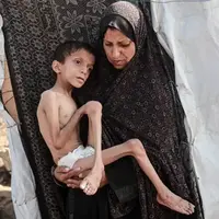 عکس/ تصاویری دردناک از سوءتغذیه کودک ۱۰ ساله اهل غزه