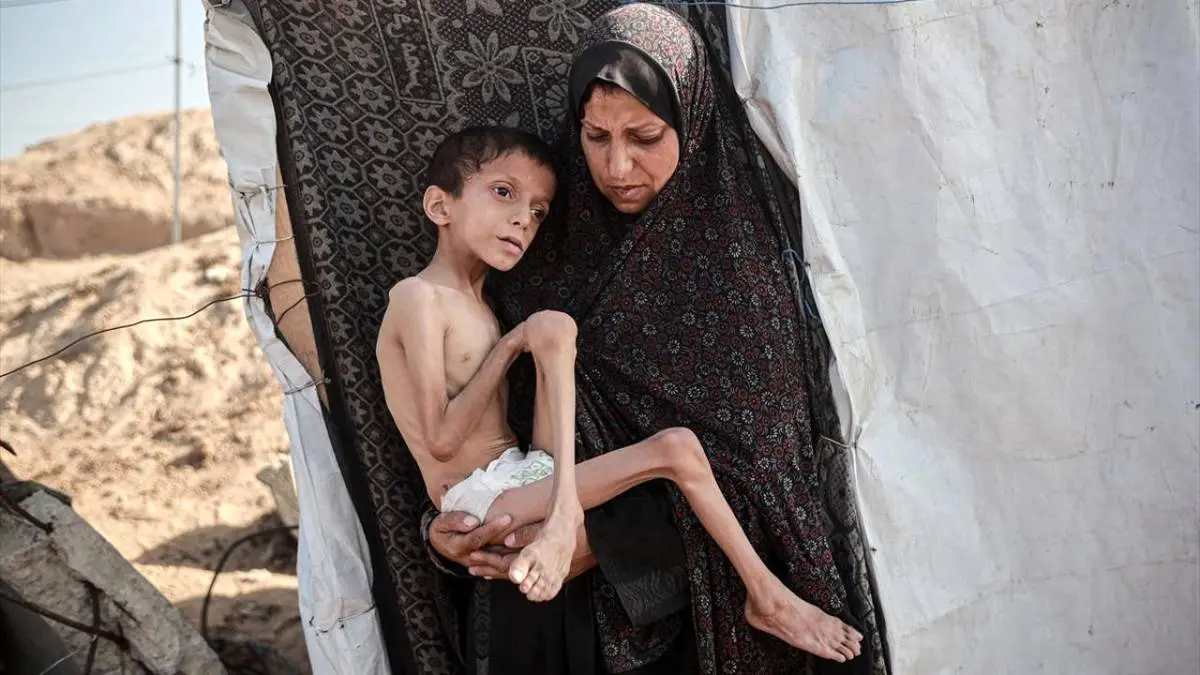 عکس/ تصاویری دردناک از سوءتغذیه کودک ۱۰ ساله اهل غزه