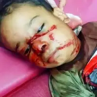 حمله سگ‌های بلاصاحب به کودک ۴ ساله در شوش
