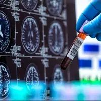 تشخیص بیماری آلزایمر با کمک هوش مصنوعی