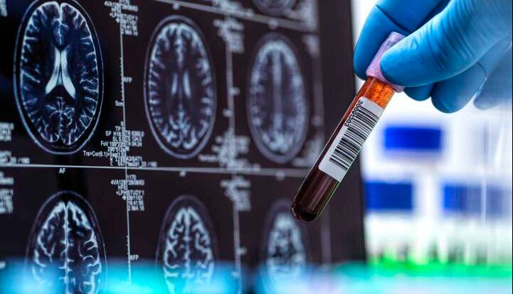 تشخیص بیماری آلزایمر با کمک هوش مصنوعی