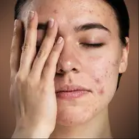 از چه راه هایی می توان جوش و جای جوش را از بین برد؟