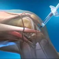 اصطلاح «زانو آب آوردن» به چه معناست؟
