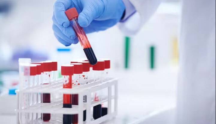 تشخیص خستگی مزمن با یک آزمایش خون پیشرفته