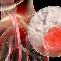 آیا ژنتیک نقشی در سرطان مری دارد؟