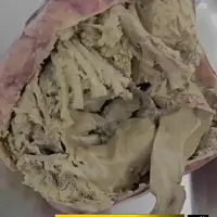 جزئیات جنین مومیایی از زبان پزشک جراح