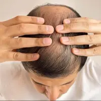این داروی درمان ریزش مو باعث ایجاد افکار خودکشی می‌شود