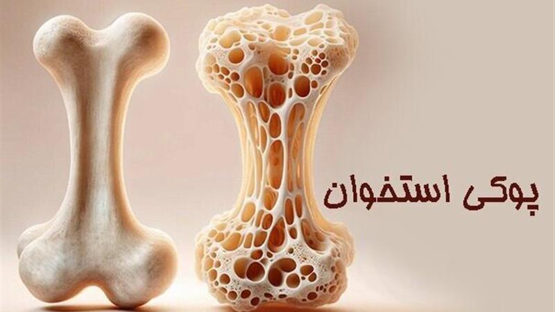 ۴۶ درصد عامل پوکی استخوان در ایلام کمتحرکی است