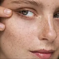 آشنایی با انواع لک‌های پوستی