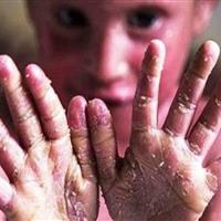 درخواست «خانه ای‌بی» از بنیاد بیماری‌های خاص: فهرست خدمات قابل ارایه به بیماران ای‌بی را اعلام کنید